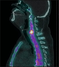 Bone scan showing tracer tagging point in spine