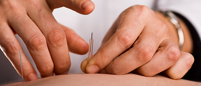 Acupunture needles being inserted