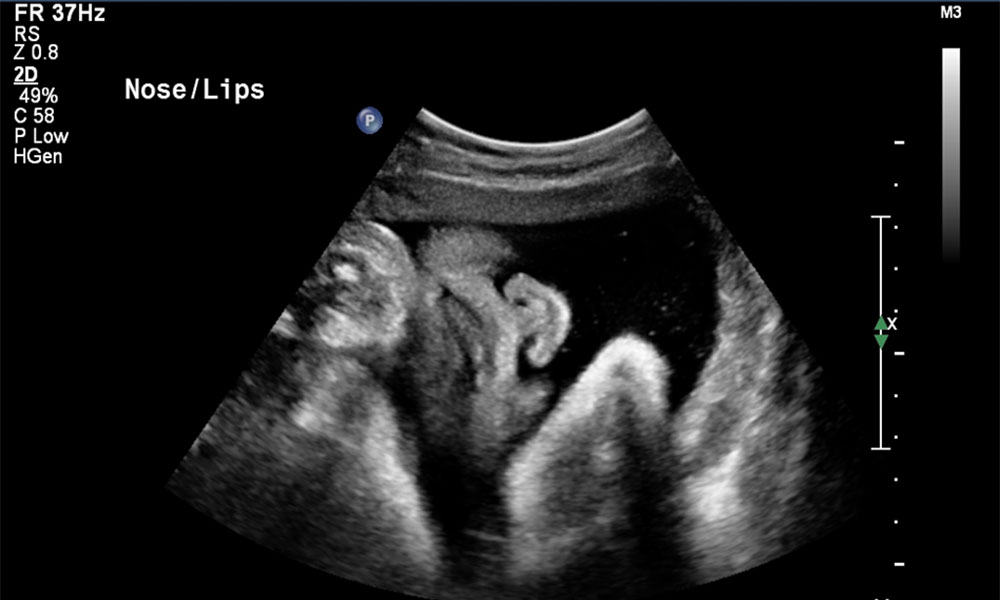 Ultrasound of baby that shows close up of face