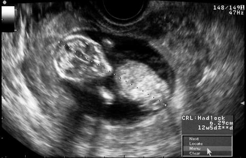 Ultrasound of baby at 16 weeks
