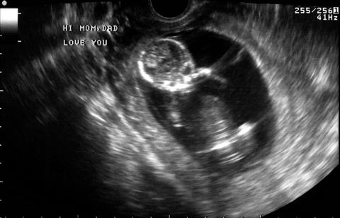 Ultrasound of baby at 20 weeks