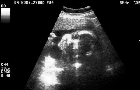Ultrasound of baby at 36 weeks