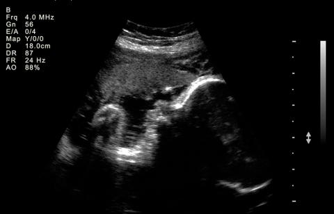 Ultrasound of baby at 37-40 weeks